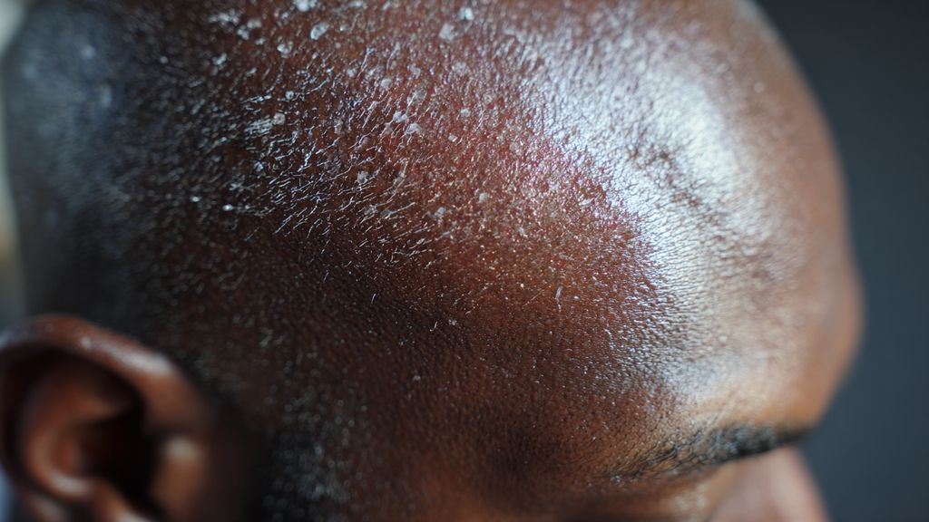 Pourquoi le cuir chevelu devient-il irrité et quels facteurs favorisent ce déséquilibre